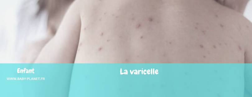 La varicelle